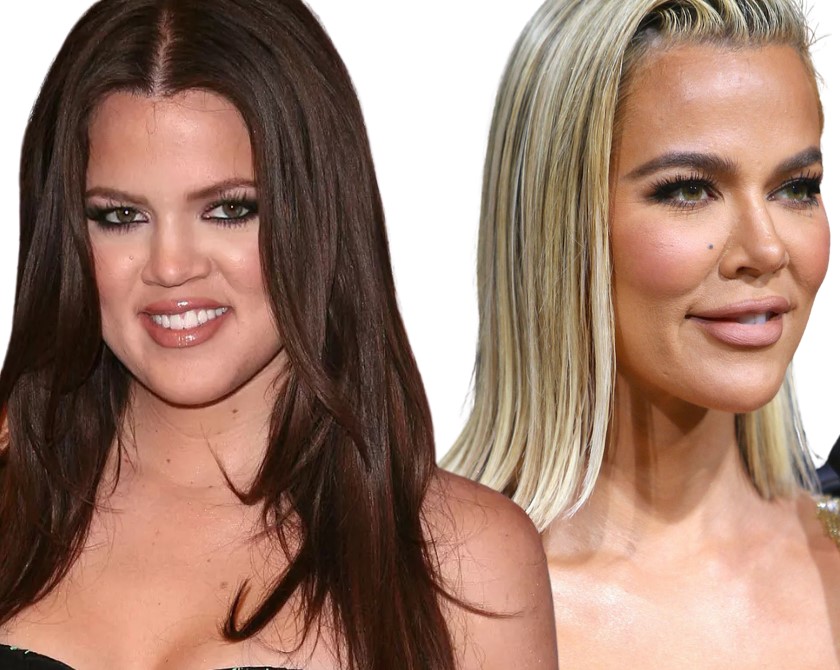 Kloé Kardashian avant chirurgie