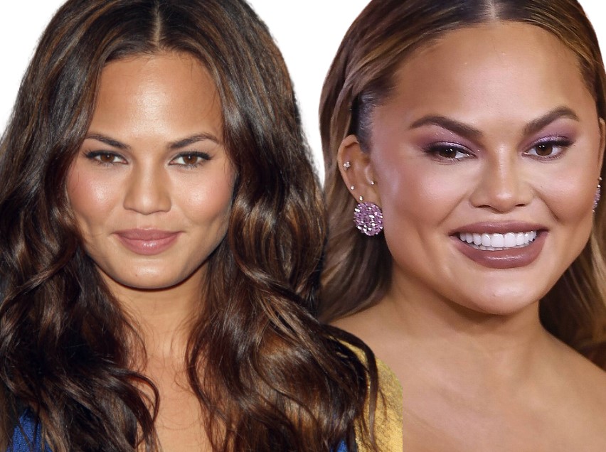 chrissy teigen chirurgie avant après