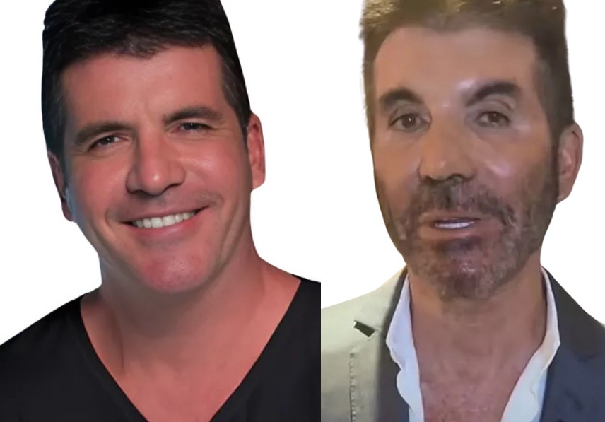 simon cowell avant apres chirurgie