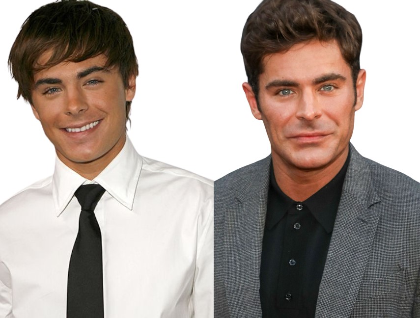 zac efron avant apres chirurgie esthetique ratées